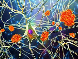 Amyloid-Plaques zwischen Nervenzellen bei Alzheimer