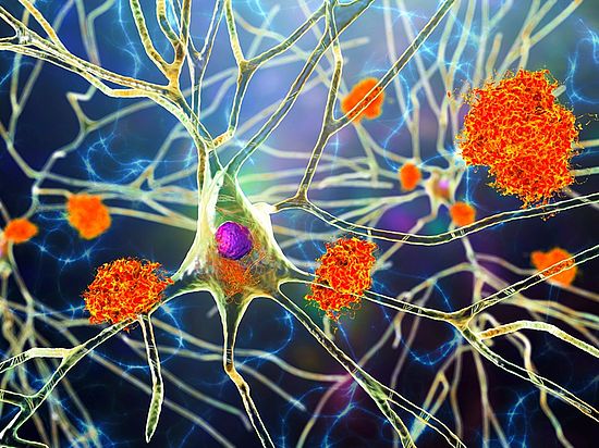 Amyloid-Plaques zwischen Nervenzellen bei Alzheimer