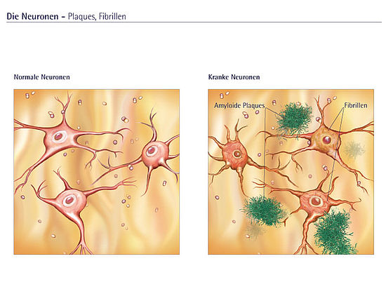 Illustration gesunder und erkrankter Nervenzellen (Neuronen)