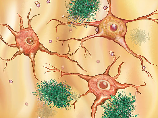 Illustration von Neuronen mit Alzheimer typischen Plaque und Fibrillen