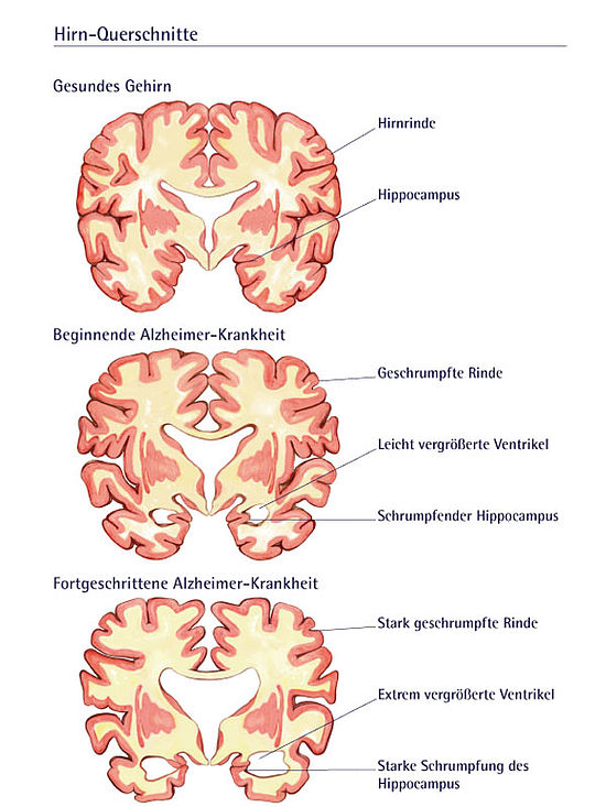 Illustration von drei Gehirnschnitten zeigt Krankheitsverlauf