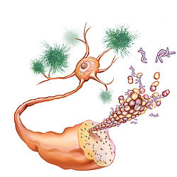 Abbildung einer erkrankten Nervenzelle