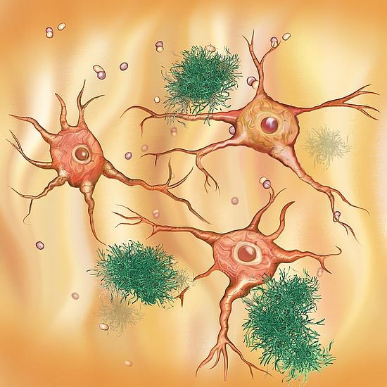 Nervenzellen bei einer Alzheimerkrankheit