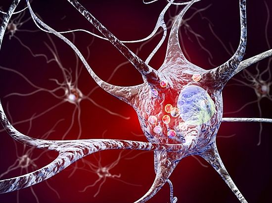 Nervenzelle mit Lewy-Körperchen bei Parkinson