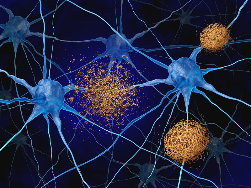 Grafische Darstellung von Neuronen mit gelb dargestellten Amyloid-Ablagerungen