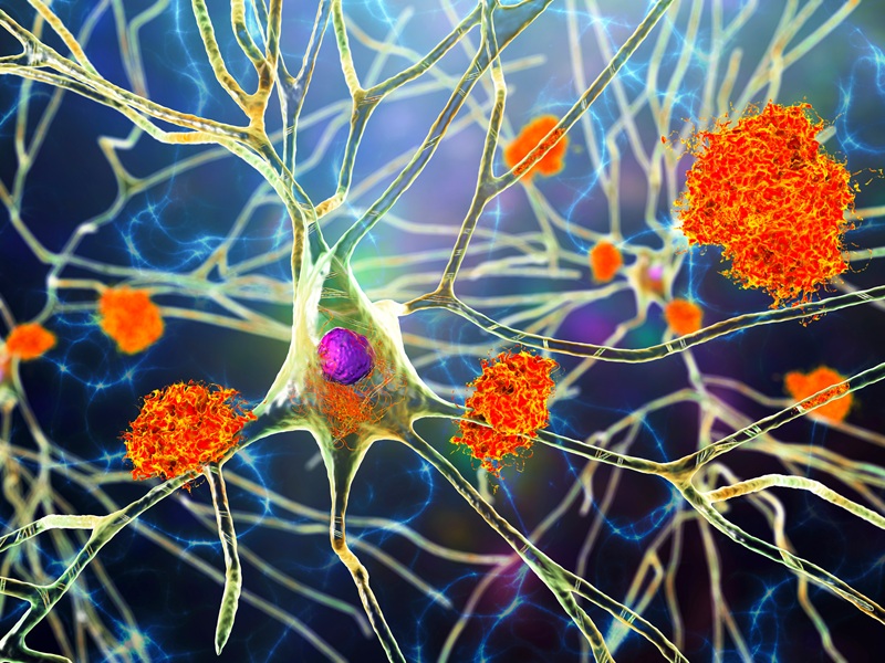 Amyloid-Plaques zwischen Nervenzellen bei Alzheimer